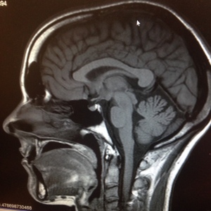 Lateral side: Medulla, pons, corpus callosum, cerebellum